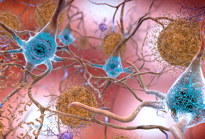 Pathologie tau dans la maladie d'Alzheimer : une nouvelle cible