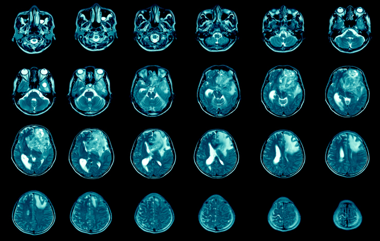 IRM : comment étudier des tumeurs cérébrales rares par apprentissage profond