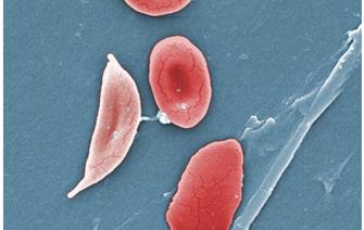 Sickle cell disease: remission of the signs of the disease in the first patient in the world treated with gene therapy