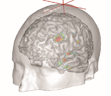 Dépression mélancolique : fusion d'image TEP, mesurant l'activité énergétique régionale, avec l'image IRM anatomique du cerveau 