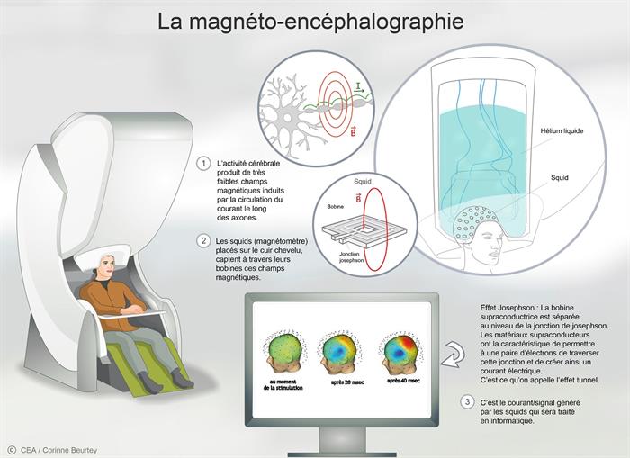 La magnétoencéphalographie