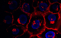 Des nanoparticules métalliques pour lutter contre le cancer du sein