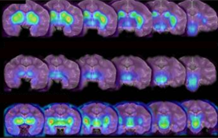 Parkinson : mieux détecter la maladie