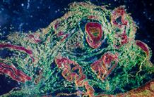 Un nouvel espoir pour l’imagerie des lymphomes