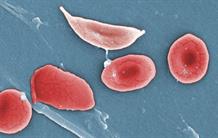 Sickle Cell Disease: Remission in the First Patient Treated by Gene Therapy