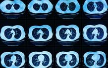 L’IA au service de l’acquisition rapide d’images d’IRM cliniques de gros organes