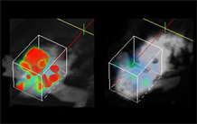 Une nouvelle lumière sur les dépôts amyloïdes pour le diagnostic d’Alzheimer ?