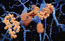 Des facteurs de la maladie d’Alzheimer transmissibles : un nouveau regard sur cette pathologie