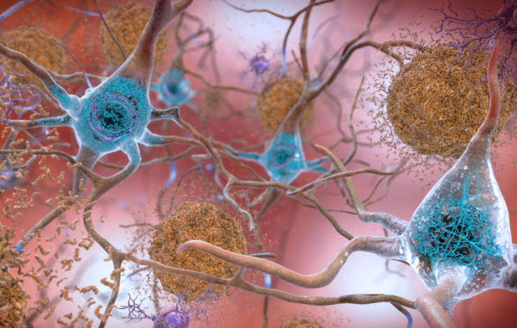Pathologie tau dans la maladie d'Alzheimer : une nouvelle cible