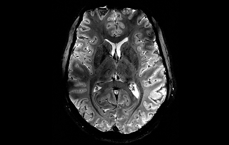 Les premières images du cerveau humain à 11,7 T
