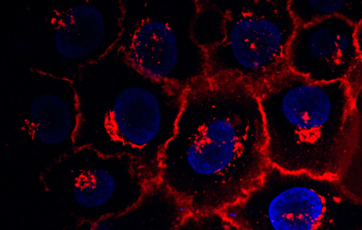 Des nanoparticules métalliques pour lutter contre le cancer du sein