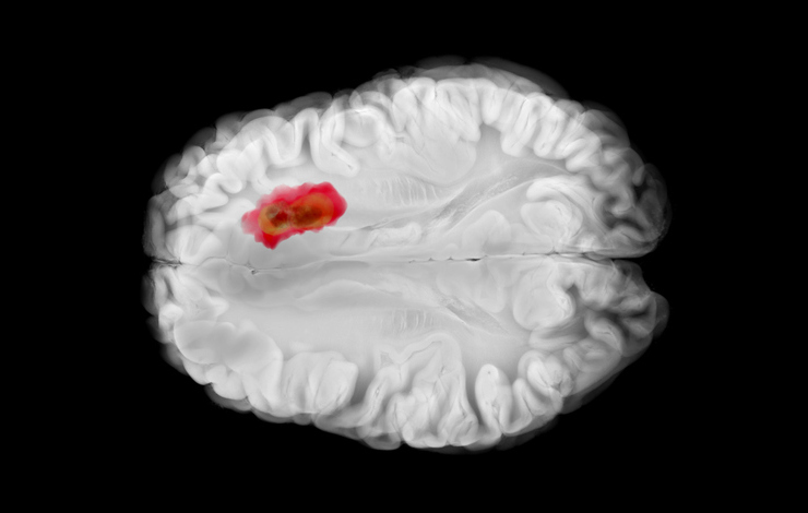 Deux anticorps théranostiques pour cibler les récepteurs aux endothélines dans des modèles précliniques de glioblastome et de mélanome