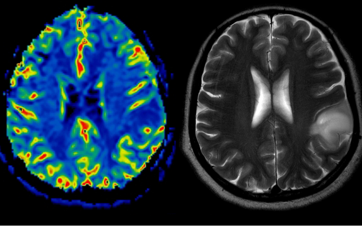 Repérer des tumeurs cérébrales grâce aux vibrations naturelles du corps