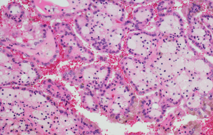 Une nouvelle piste dans la lutte contre le cancer du rein ?