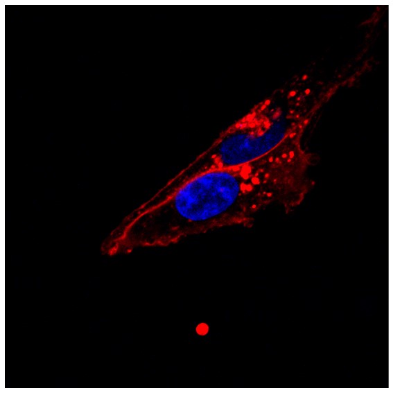 Les nanoparticules, alliées des radiothérapies ciblées contre les cancers du sein