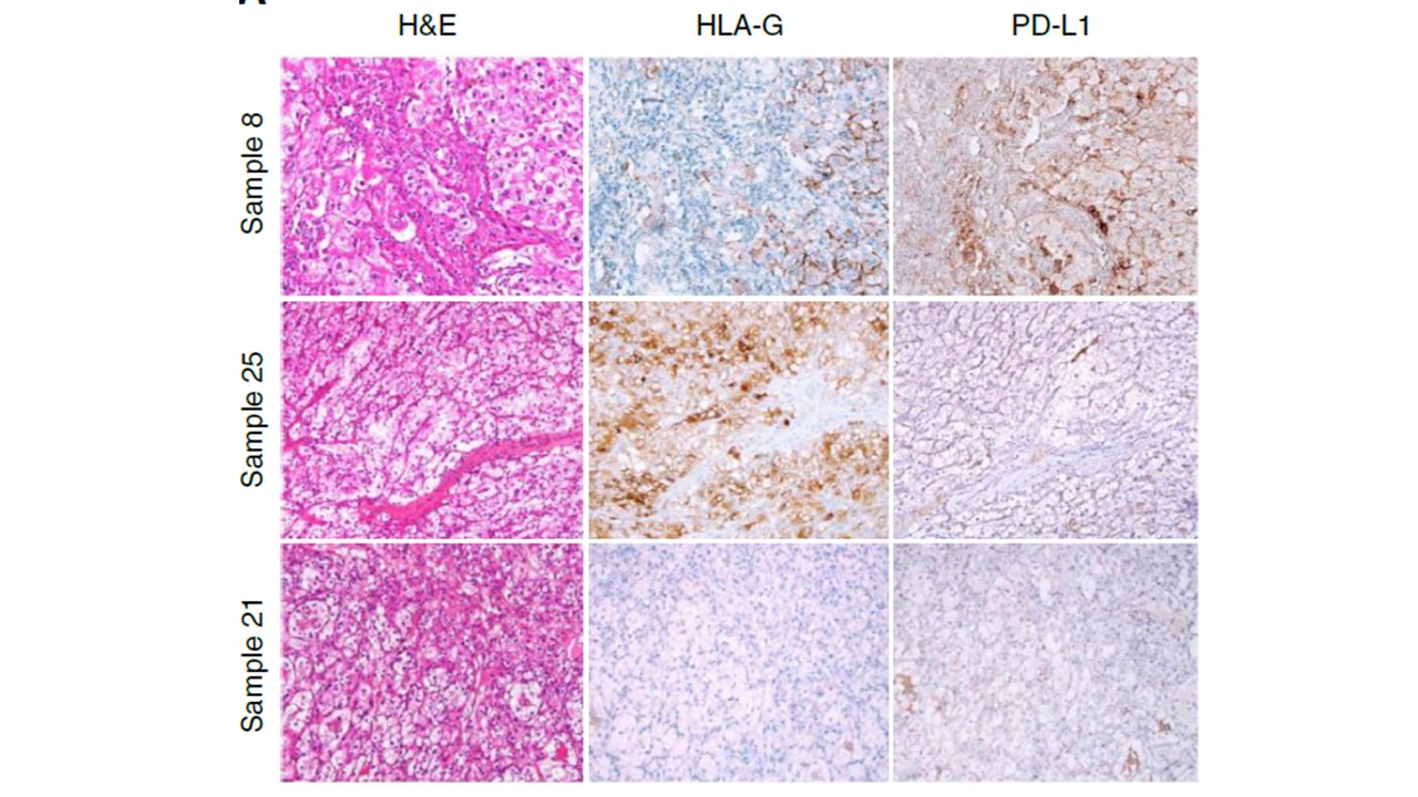 Cancer du rein : une population méconnue de lymphocytes T ouvre de nouvelles pistes d’immunothérapie