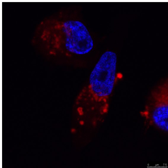 Nanoparticles as enhancers for targeted radiotherapy against breast cancer