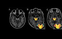  PET Imaging to visualize neuroinflammation in patients with Parkinson's disease