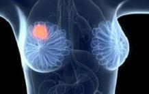 Etude des textures tumorales grâce à la TEP