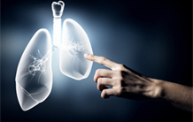 Cancer : améliorer le passage cérébral des thérapies ciblées