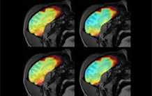 Towards greater accuracy in the measurement of temperature variations induced by MRI examinations