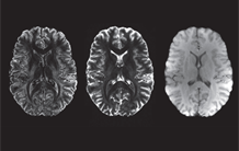 IRM : une méthode d’acquisition multiparamétrique robuste pour cartographier le cerveau à ultra-haut champ