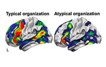 An atypical cerebral organization for language