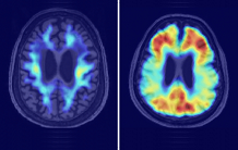 Amyloid and tau imaging for diagnosis of progressive amnesia