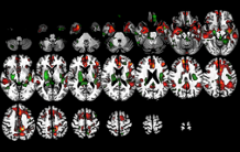 L’IRM du sodium à 7T confirme une atteinte métabolique précoce dans la maladie d’Alzheimer