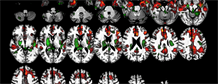 7T Sodium MRI confirms early metabolic damage in Alzheimer's disease