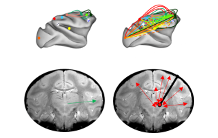 Deep brain stimulation of the thalamus restores signatures of consciousness