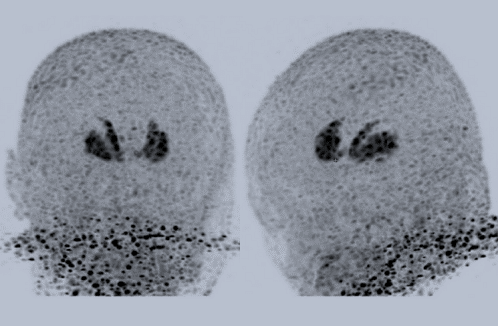 Le ‘motif du lapin’ en imagerie TEP pour une évaluation diagnostique des syndromes parkinsoniens