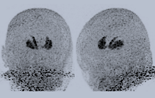 Le ‘motif du lapin’ en imagerie TEP pour une évaluation diagnostique des syndromes parkinsoniens