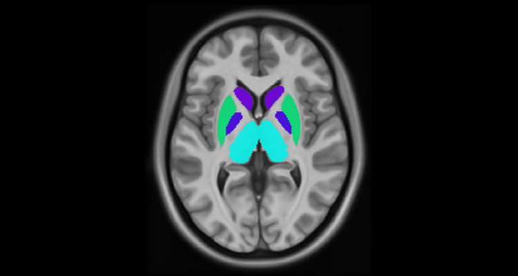 Troubles causés par l’alcoolisation fœtale : les altérations de la substance grise profonde comme biomarqueur diagnostic