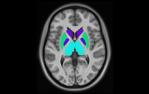 Troubles causés par l’alcoolisation fœtale : les altérations de la substance grise profonde comme biomarqueur diagnostic
