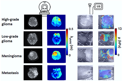 Diagnosing brain tumors with passive MRI elastography