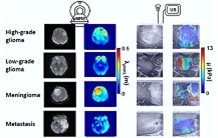 Diagnosing brain tumors with passive MRI elastography