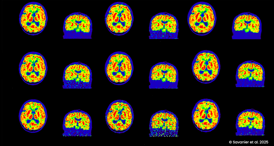 Reconstruire des images TEP avec plus de fiabilité grâce à une approche de régularisation « Plug-and-Play » convergente