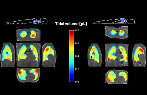 Investigating respiratory dynamics using 3D spirometry in pulmonary MRI