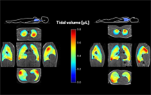 Investigating respiratory dynamics using 3D spirometry in pulmonary MRI