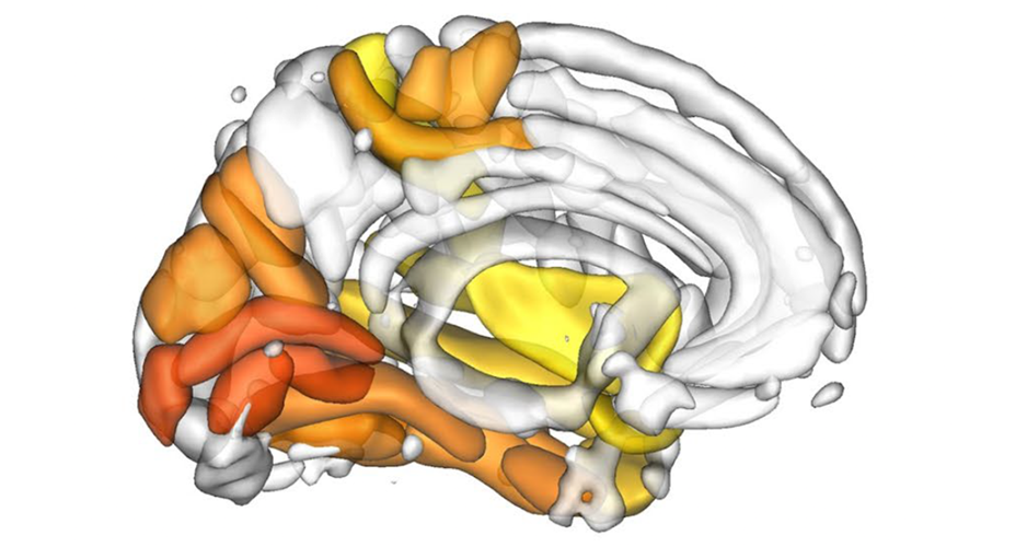 AI to Reveal the Neurodevelopmental Component of Psychiatric Disorders