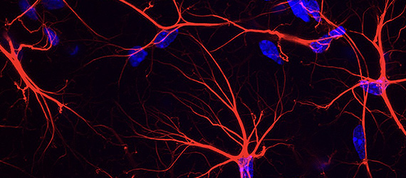 Maladie de Huntington