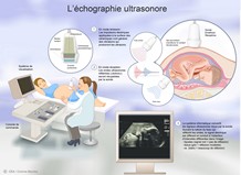 ​L'échographie ultrasonore