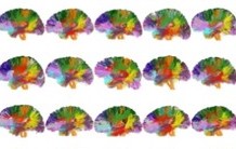Premier atlas « in vivo » des connexions du cerveau humain et de leur microstructure